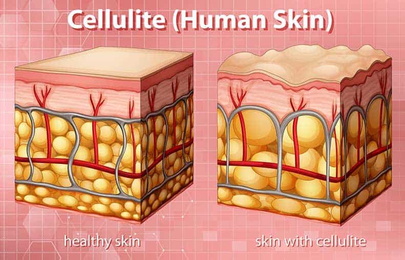 Parallelo Health - your source for health, workouts, food, supplements and more - blog - 6 Exercises to Reduce Cellulite on Your Butt and Legs - cellulite skin